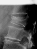 vertebral fracture img